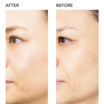 「美容クリニックでシミとり」をした点在ジミは、2年後の今どうなっている!?