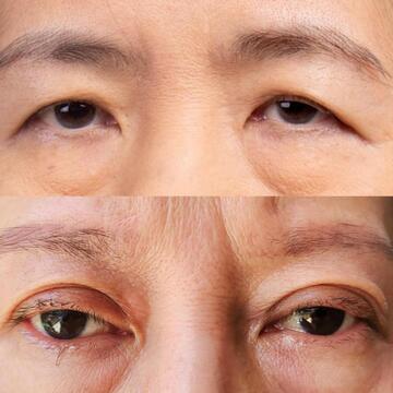 まぶたのたるみと眼瞼下垂はどう違う？ 治療に保険はきく？ 専門医が解説！